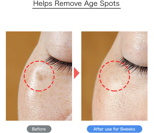 Helps Remove Age Spots